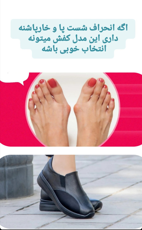 انحراف انگشتان پا